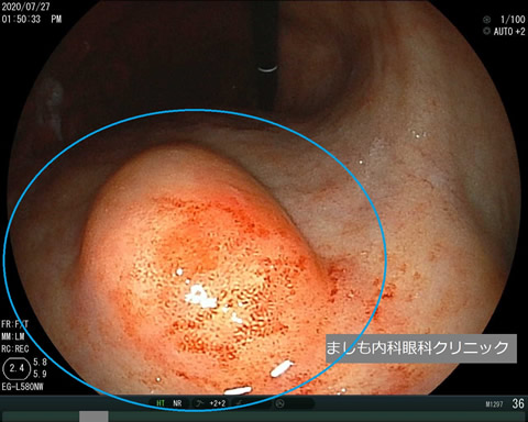 胃粘膜下腫瘍1